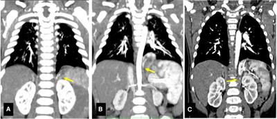 Intradiaphragmatic pulmonary sequestrations: a surgical challenge. Case series
